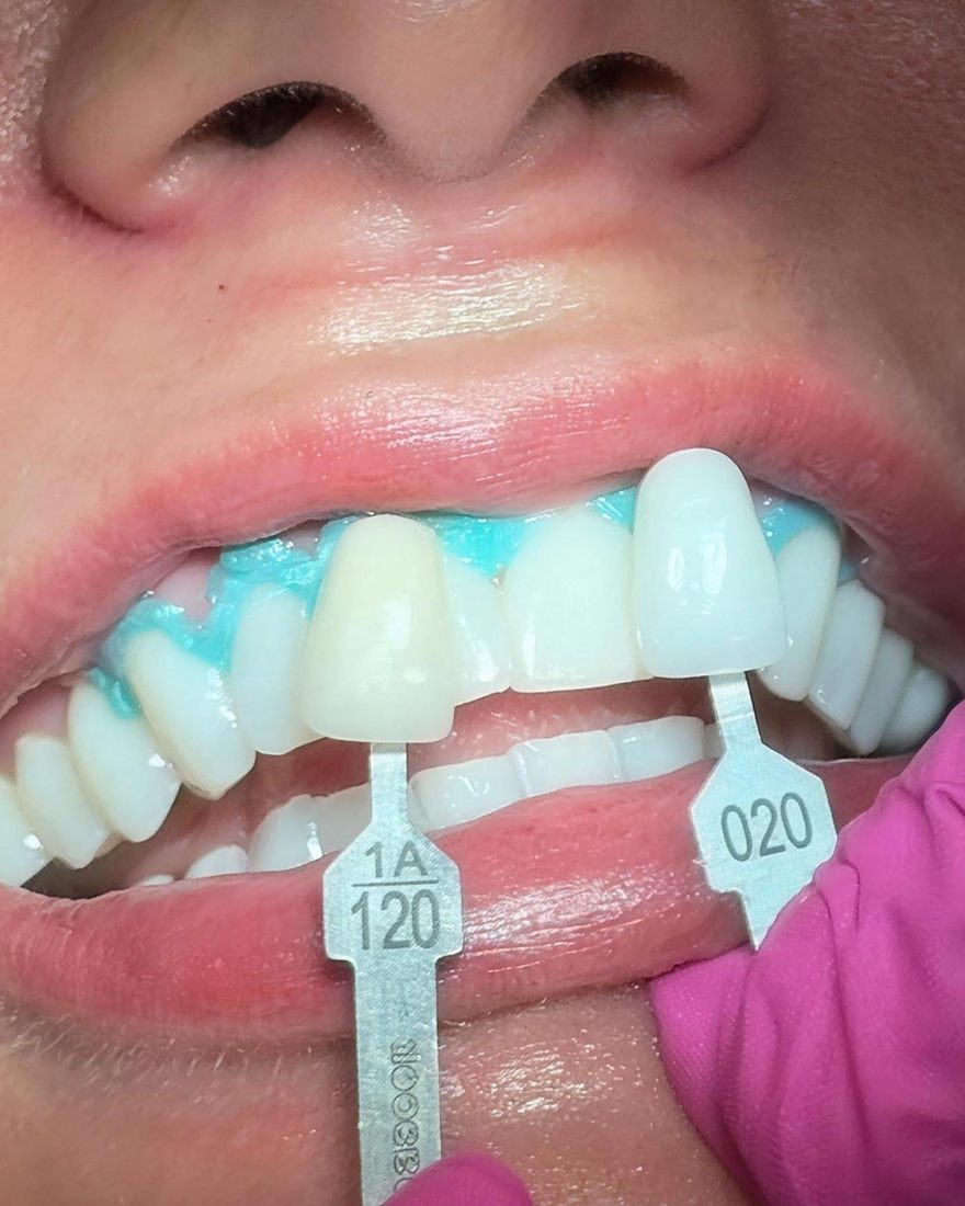 Selección de color con guía Vita durante un tratamiento estético dental